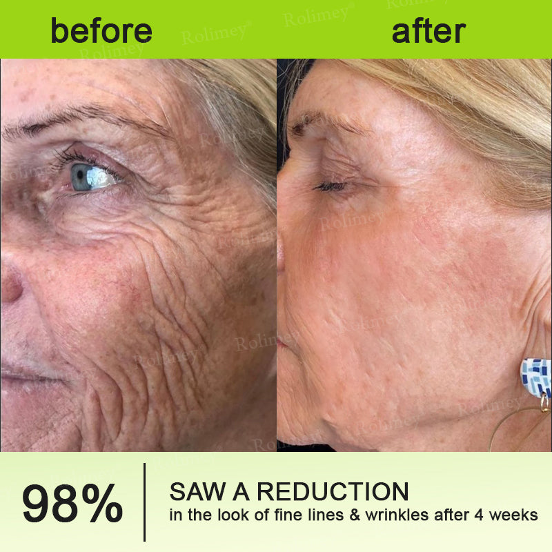 🔥Final 3 Hours: 70%OFF🔥 QIAWI™ Botulinum & Vita-A Retinol Shot Wrinkle-Lift Tightening cream✨